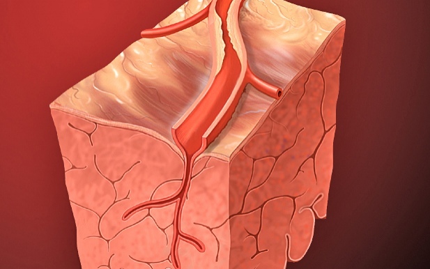 Reinigung der arterien von cholesterin