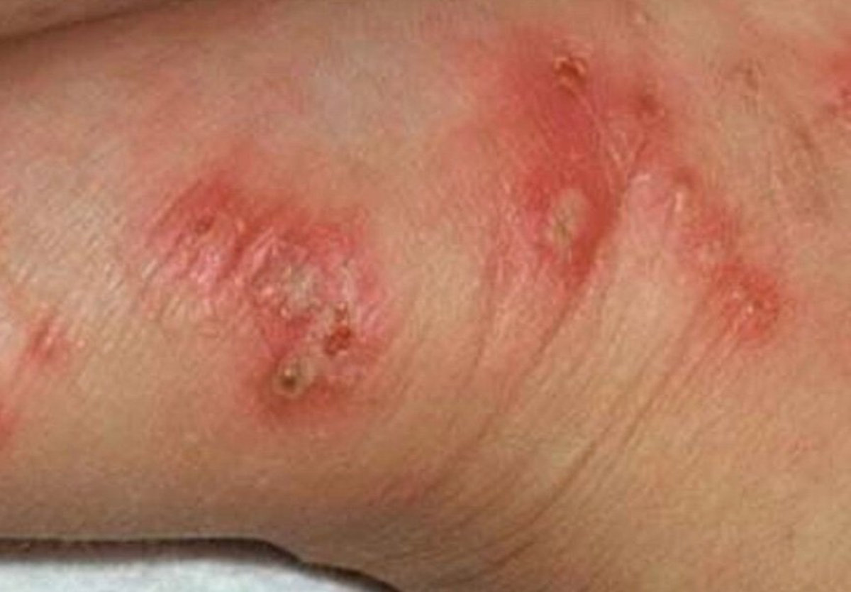 92 Tote durch Bakterien im Boden