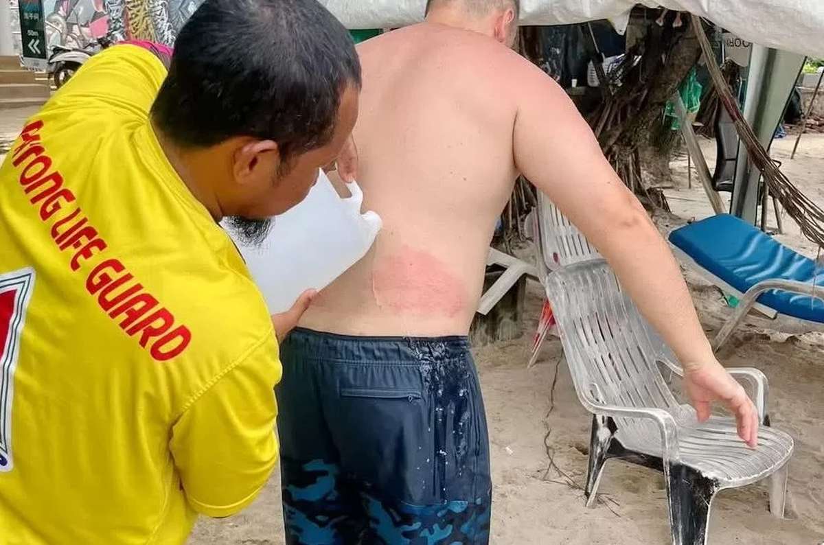 Touristen in Phuket von giftigen Quallen verletzt