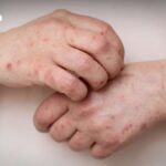 Mpox-Alarm: Behörden verstärken Kontrollen