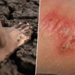 Tödliche Infektion: Thailand warnt vor steigenden Fällen